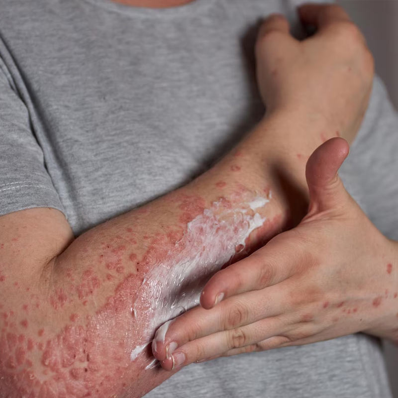 Skin Disorders